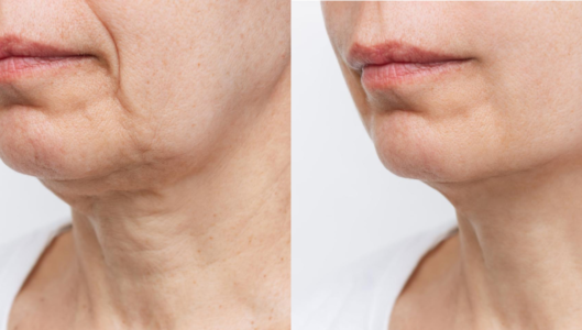 Double Chin Treatment with Stem Cell: A Revolutionary Approach for Women