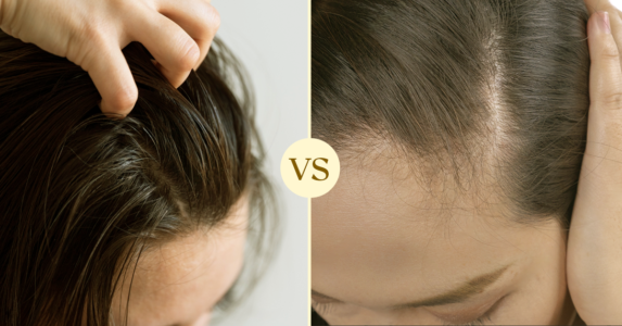 Stem Cell Hair Restoration vs. Hair Transplants: A Comprehensive Guide for Women